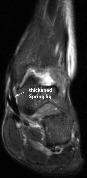 MR findings of spring ligament injury: The SM band is most commonly injured. The SM band injury may show thickening greater than 5 mm or be atretic if less than 2 mm.