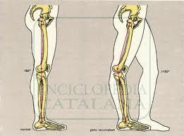 Common Knee Pathology Genu Valgum Genu Varum Genu Recurvatum Patellar Tendonitis Osgood-Schlatter Disease