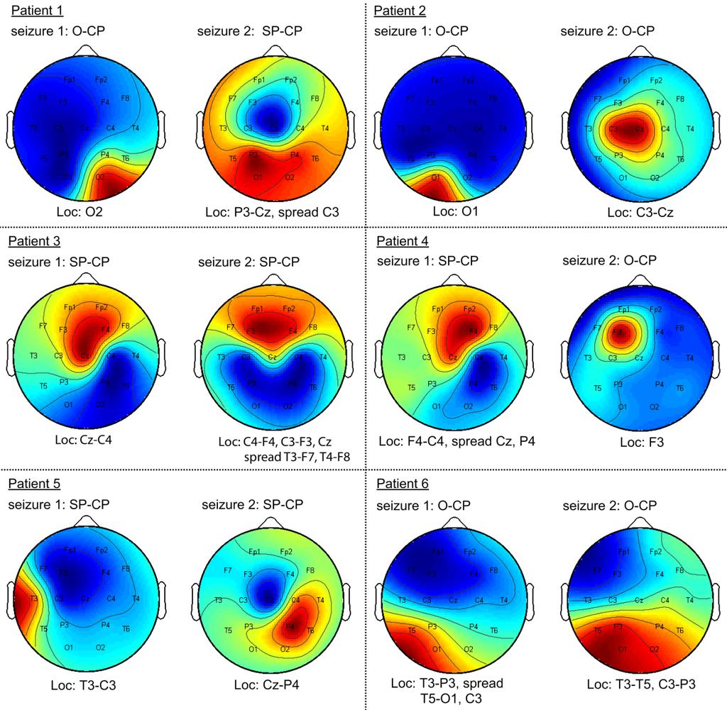 Validation study Comparison with visual analysis of the EEG by a neurophysiologist.