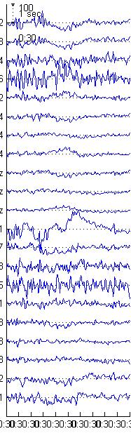 monitoring Interictal EEG
