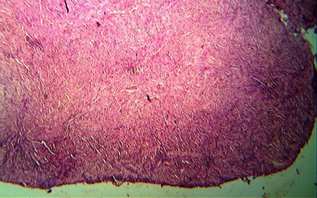 Photomicrograph showing biphasic tumour squamous cell carcinoma admixed with spindle cell cells arranged in fascicles and irregularly. (H& E component.