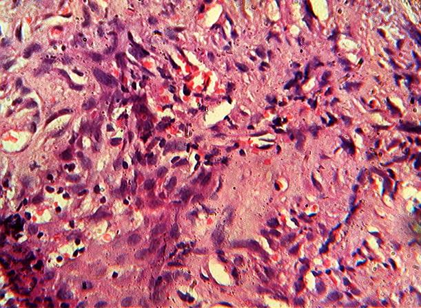 [5,6] Exact cause of spindle Spindle cell carcinoma also known as sarcomatoid cell carcinoma is not known, but strongly associated carcinoma is a rare malignancy of head