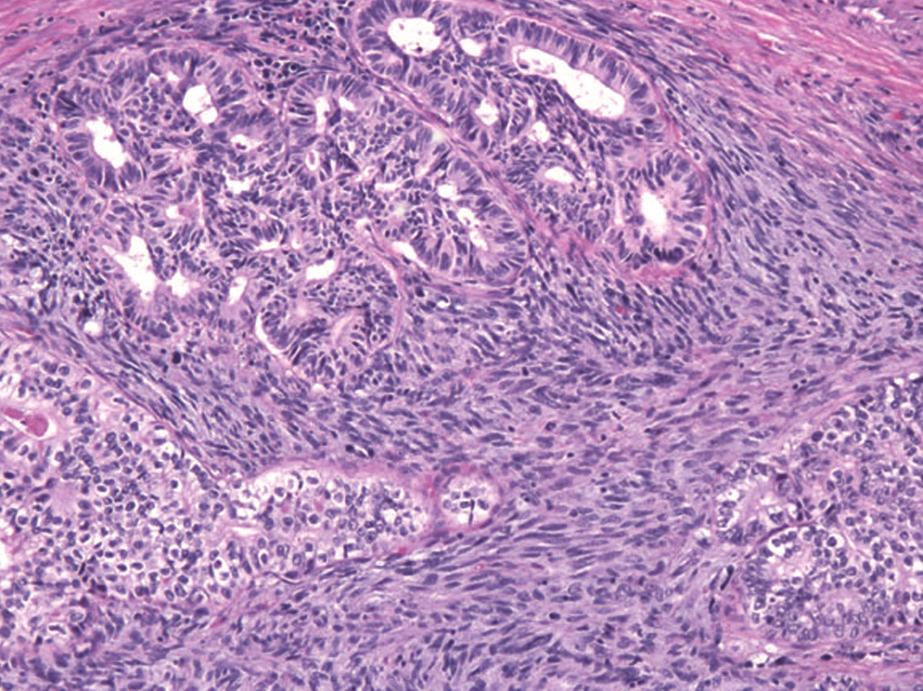 spindle: spindle cell carcinoma; AE1/3: cytokeratin cocktail AE1/AE3; CK7: cytokeratin 7; Vim: vimentin; NE: neuroendocrine markers chromogranin, synaptophysin, and CD56; AFP: alpha fetoprotein; Hep: