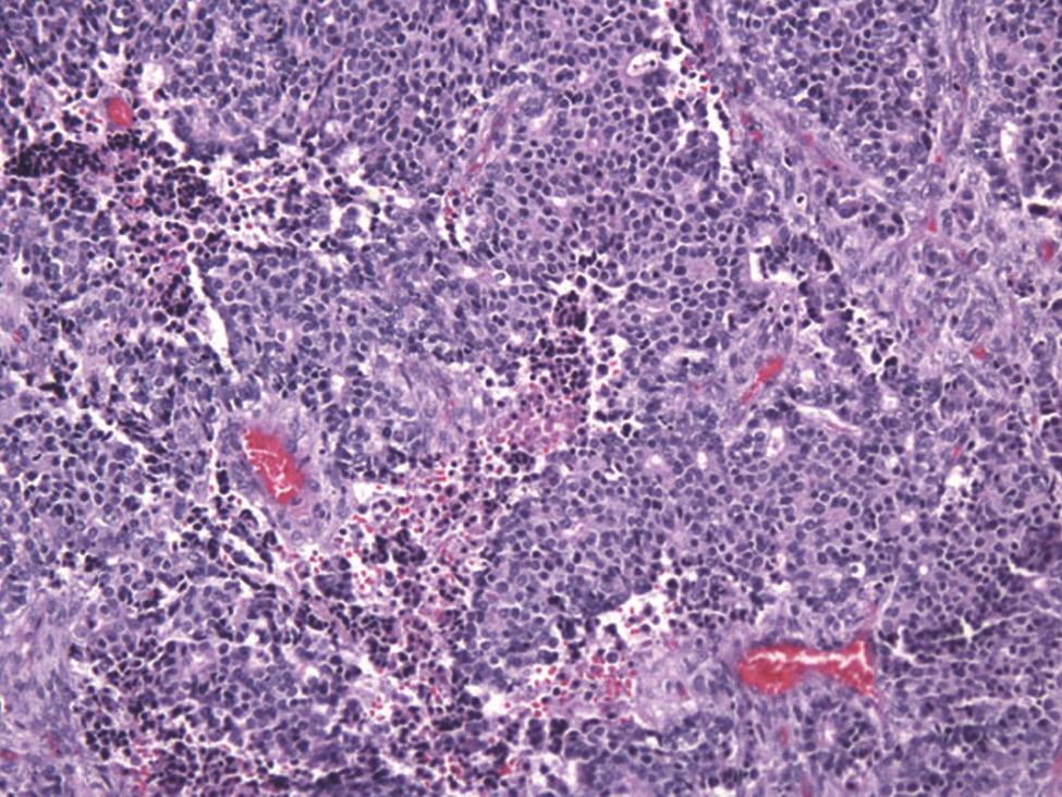 Microscopically, the tumor was composed of islands of conventional adenocarcinoma and clear cell carcinoma surrounded by malignant-appearing spindle cells (Figure 2).