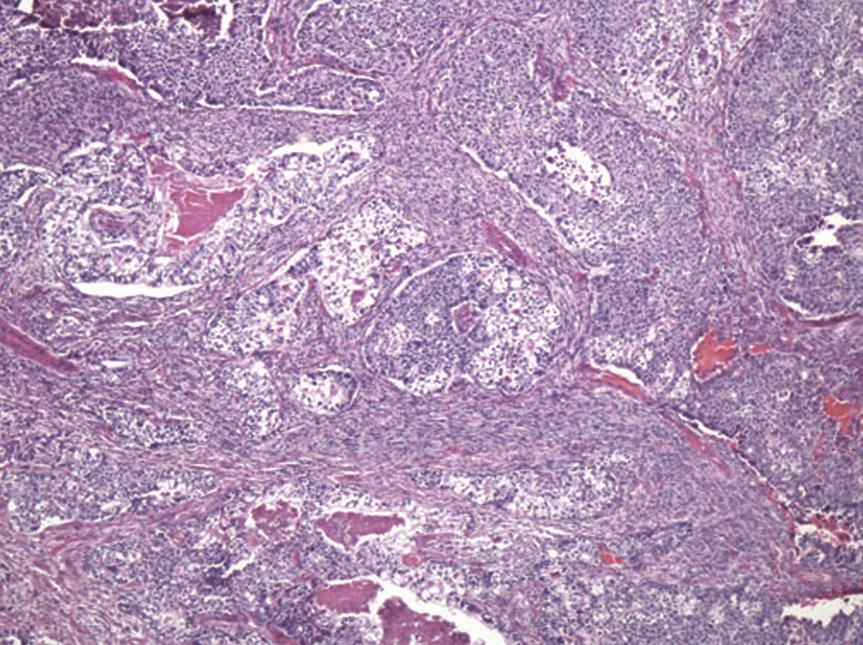 Additionally, there were separate areas of large cell neuroendocrine carcinoma (LCNEC), which formed relatively broader sheets with focal rosette-like structures and abundant necrosis (Figure 3).