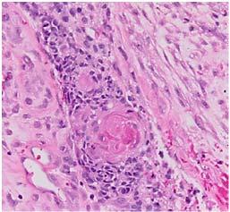 Case 2 Gliosarcoma ~ 2% of high grade gliomas; Feigin, Sarcoma arising in glioblastoma of the brain Am J Path 1958 At least 2 components: GBM and mesenchymal Heterologous components: osteosarcoma,