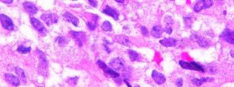 Metastatic germ cell carcinoma E.