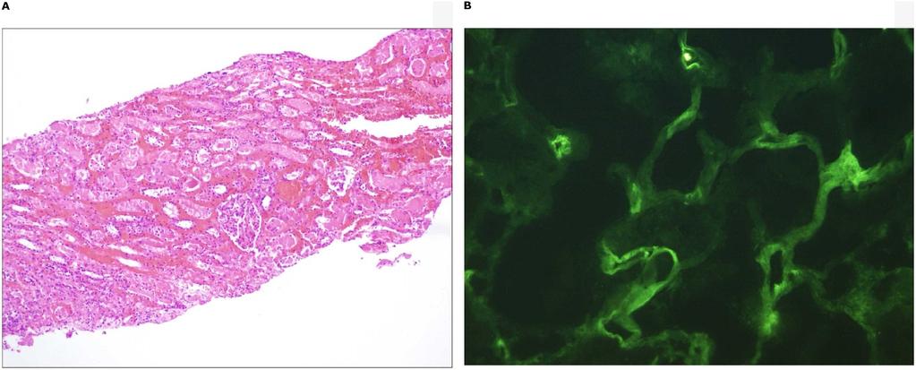Pediatric solid-organ transplantation Pathology of Antibody-Mediated Rejection In AMR, alloantibodies preferentially attack the peritubular capillaries and glomerular capillaries; by contrast, T