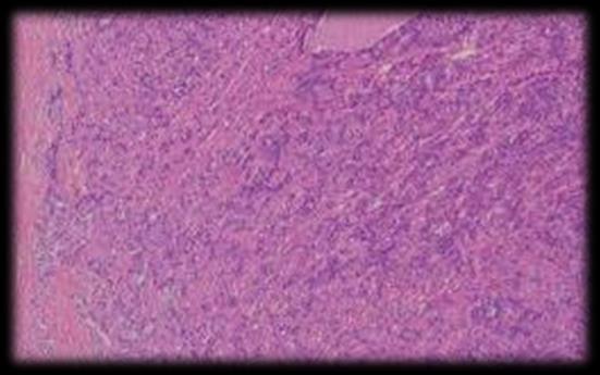 Myoepithelial cell Spindle cell adenomyoepithelioma