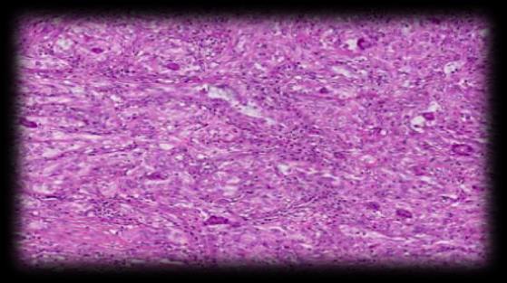 Fibromatosis, PASH Myofibroblastoma Nodular Fasciitis SFT