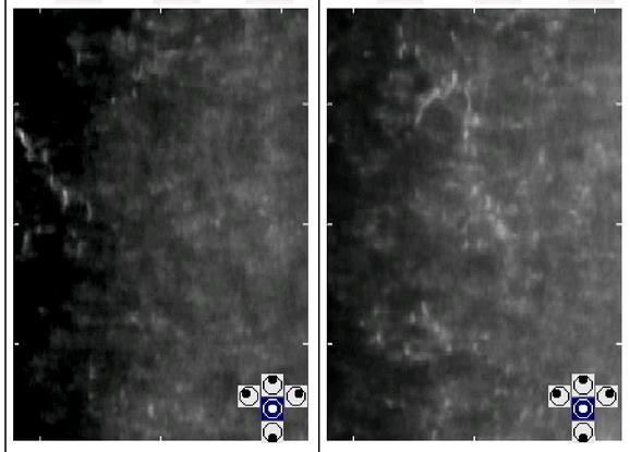 Post Refractive CEIOL Case Pre-Op Specular Microscopy Pachymetry: