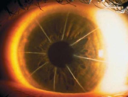 Radial Keratotomy Hyperopic drift over time and diurnal fluctuations Perform IOL measurements in the morning and in the afternoon Aim for low myopia