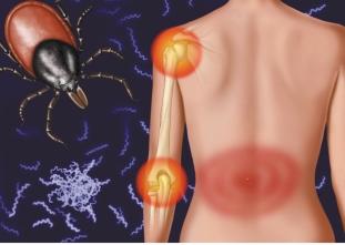 CME Lyme Disease Early Disseminated Three to 12 weeks following the tick-bite manifestations of early Lyme disease, the disseminated stage may ensue.