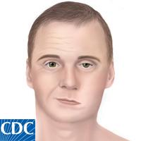 Both pictures were taken from the CDC website (2015) If left untreated, the bacterial infection can spread to other parts of the body such as, EM lesions in other areas of the body, facial or Bell s