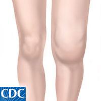 Figure 11. This image shows the swelling in a patient with Lyme diseases knee, different from arthritis.