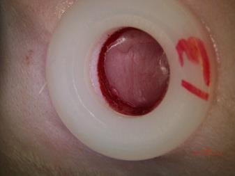evaluate the progress of wound healing early in infection.