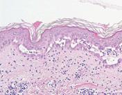 2 Blistering and Pustular Diseases d e Fig..21-2 Pemphigus vulgaris. d: A mix of blisters, erosion and crusts is present on the trunk. e: Blisters appear on normal skin. Fig..22 Histopathology of pemphigus vulgaris.