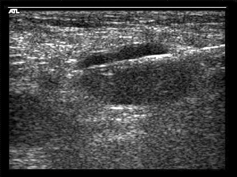 (B) The ultrasonography guided large needle core biopsy shows correct sampling for the eccentric lymph node cortex.