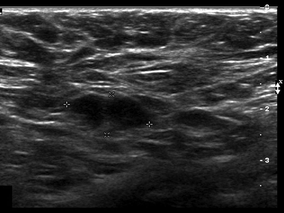 The Safety and Efficiency of the Ultrasound-Guided Large Needle Core Biopsy of Axilla Lymph Nodes A B Fig 3. A 40-year-old woman with left modified radical mastectomy 5.5 years ago.