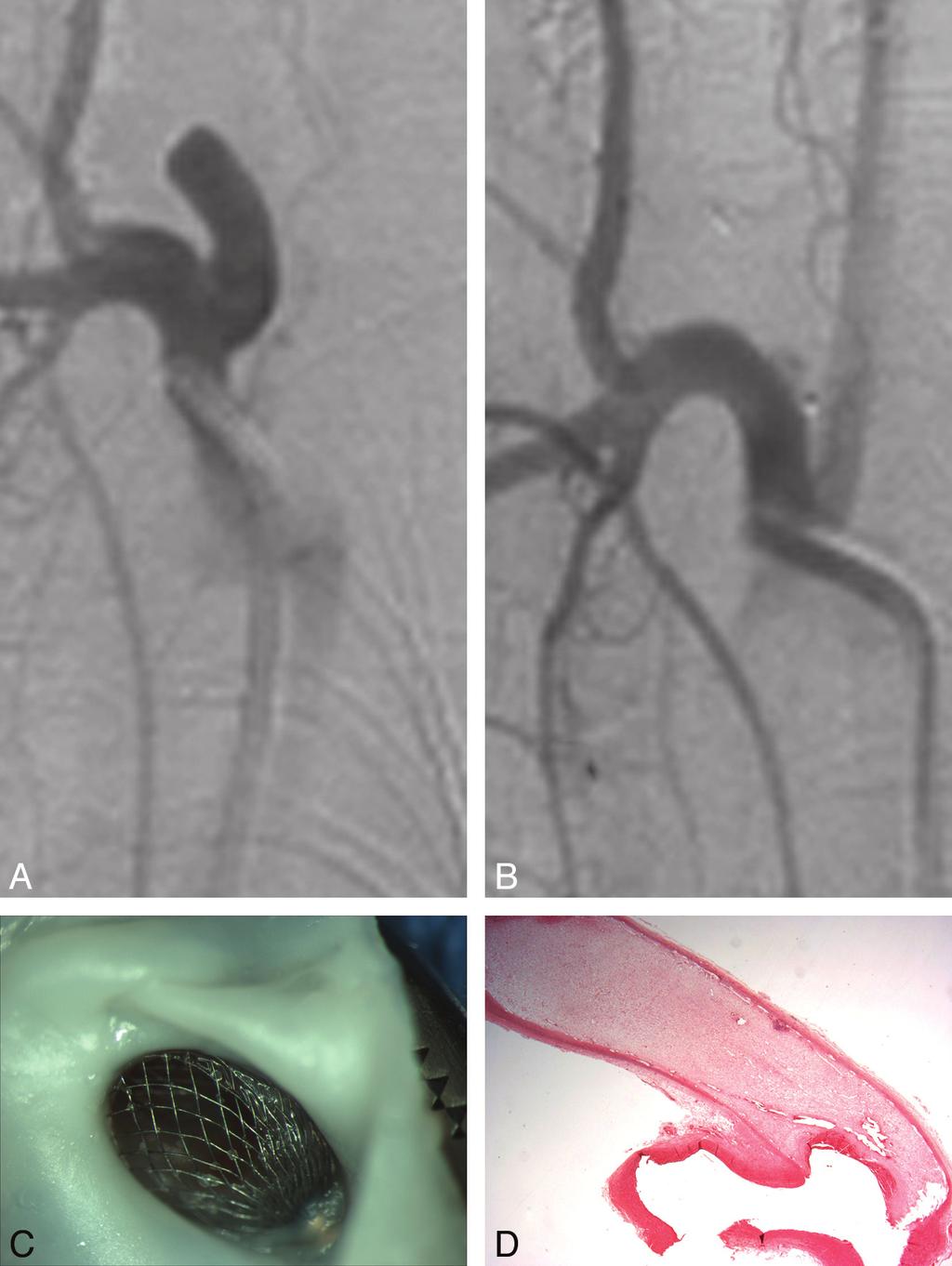 Fig 3. Representative images from case 2 in the Table. A, DSA before treatment shows the aneurysm. B, Image at sacrifice shows a small remnant at the neck.