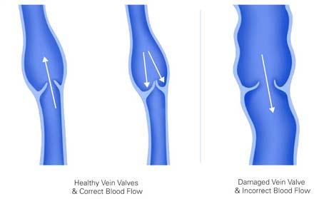 Great Saphenous Vein Deep Vein Perforating Veins Small Saphenous Vein Atlas of Vascular Surgery, Linton, 1973.