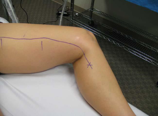 marks on the leg with surgical marker to