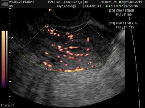 The endometrial subendometrial blood flow distribution pattern was determined by demonstrating pulsatile color signals in the subendometrial and endometrial regions.