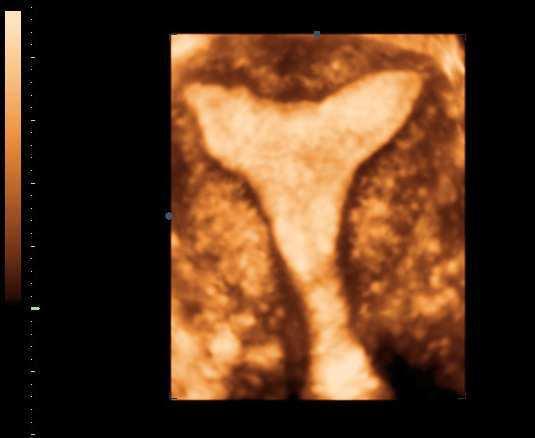 34 In Vitro Fertilization Innovative Clinical and Laboratory Aspects Photo 1. 3D Ultrasound of uterus and endometrium 3D US images can be obtained by two methods: freehand and automated.
