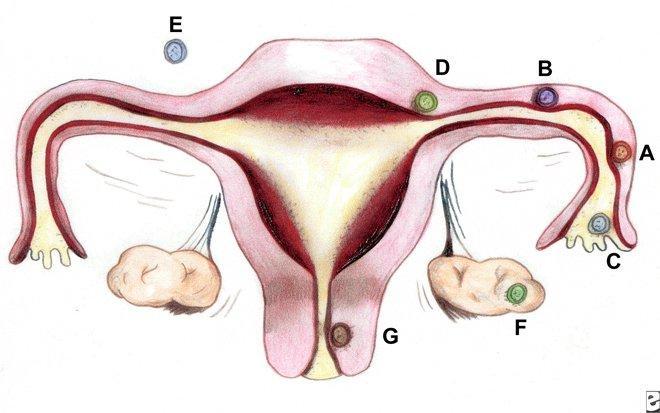 Ectopic pregnancy Inplantation of the fetus in the fallopian tube, cervix, ovaries, abdominal cavity Must exclude when examining
