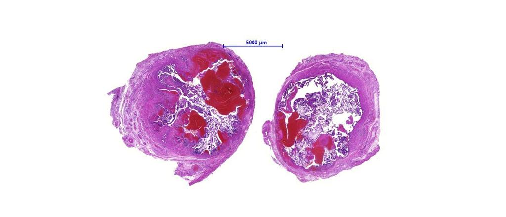 Extrauterine gravidity - microscopy Placental tissue: chorionic villi, decidua,
