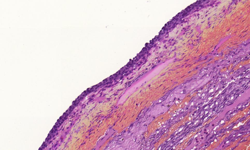 Granulosa or luteal cell lining Symptoms: