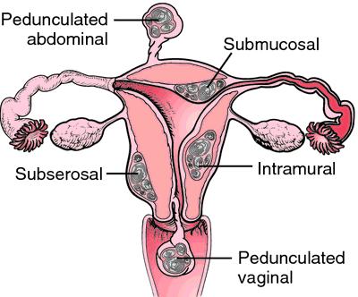 Tumors: Corpus uteri Smooth muscle tumors: leiomyoma and
