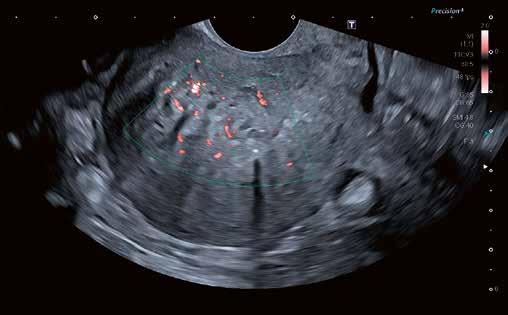 Advances in transvaginal scanning imaging and their clinical application 3 Fig.
