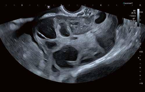 As a result the peri-ovulatory endometrium appears very thickened ( and patients often present with