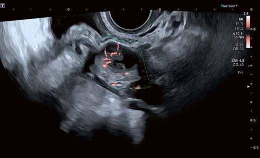 The likelihood of ovarian malignancy can be demonstrated by good-quality CFM assessment at an extremely early stage even before there is any significant enlargement of the ovary itself, particularly