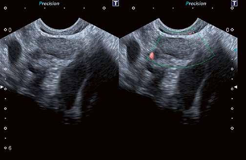 6 Advances in transvaginal scanning imaging and their clinical application C) Fig.