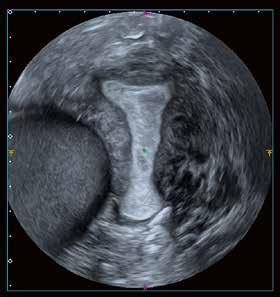 Nevertheless, the ability to demonstrate very fine neovascularity within tissues remains an important factor in the ultrasound evaluation of gynaecological lesions and pathological disease generally.
