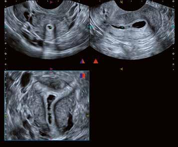 8 Advances in transvaginal scanning imaging and their clinical