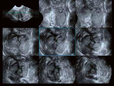The ability to manipulate stored ultrasound data and select different anatomical sections at will facilitates careful evaluation of complex gynaecological disease.