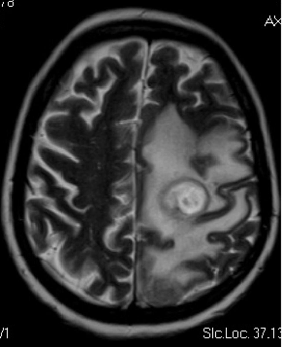 Fig. 9: T2W - nodular hyperintense lesions, due to a greater degree