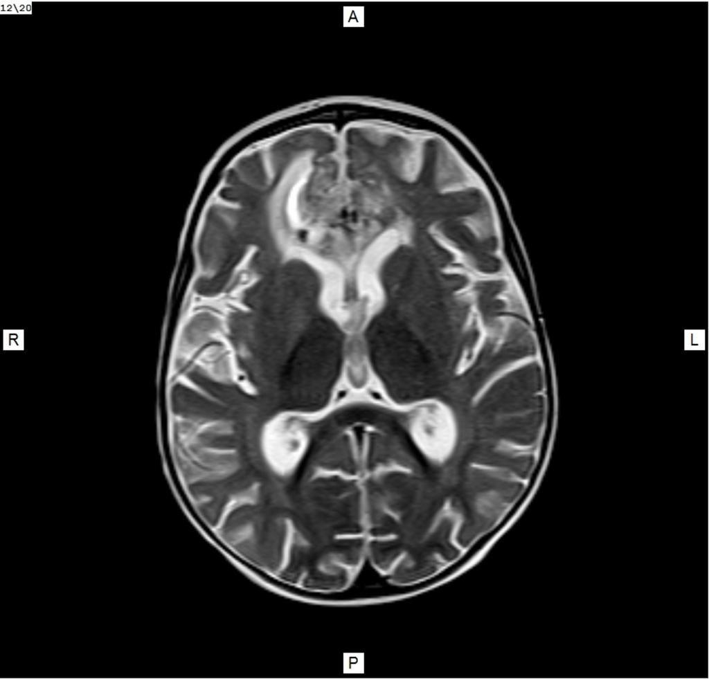 Fig. 10: T2W - more hypointense lesion, due to high cellular density