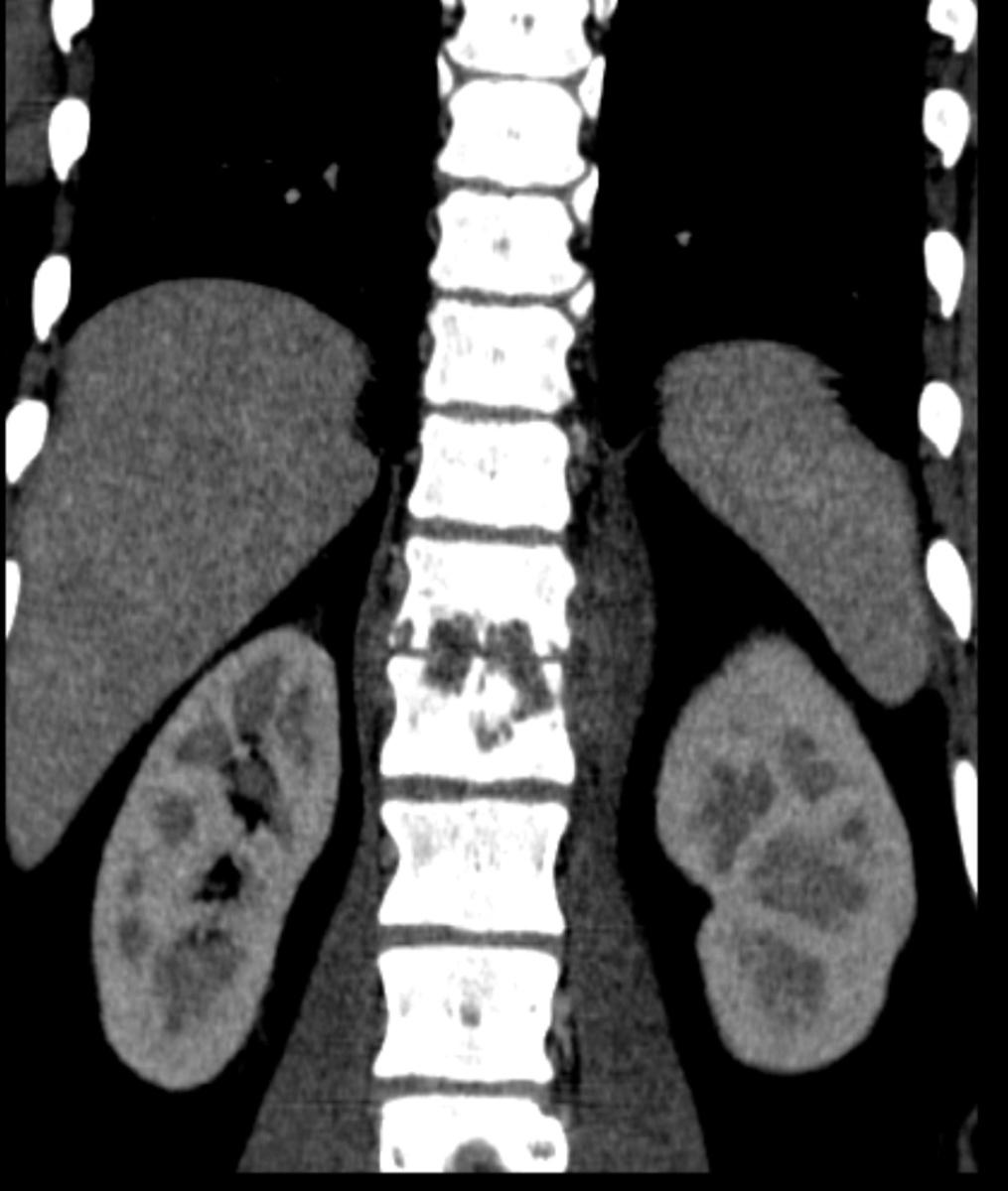 Fig. 12: Sagital CT - two adjacent vertebral bodies end plates erosion Fig.