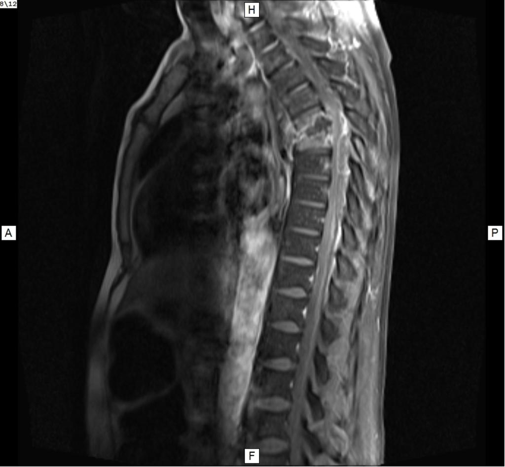 Fig. 15: T1W precontrast sagital - adjacent vertebral hypointensity and vertebral bodies height loss Fig.