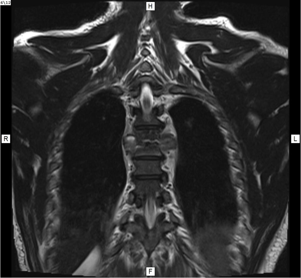 Fig. 19: T2W coronal - vertebral body destruction and