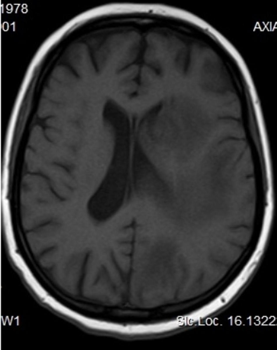Fig. 5: T1W axial - nodular isointense lesions in the