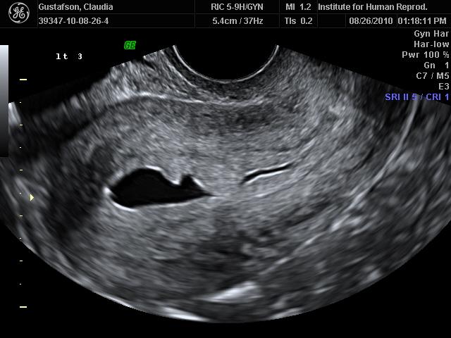 3-D Ultrasound and Dopplers in