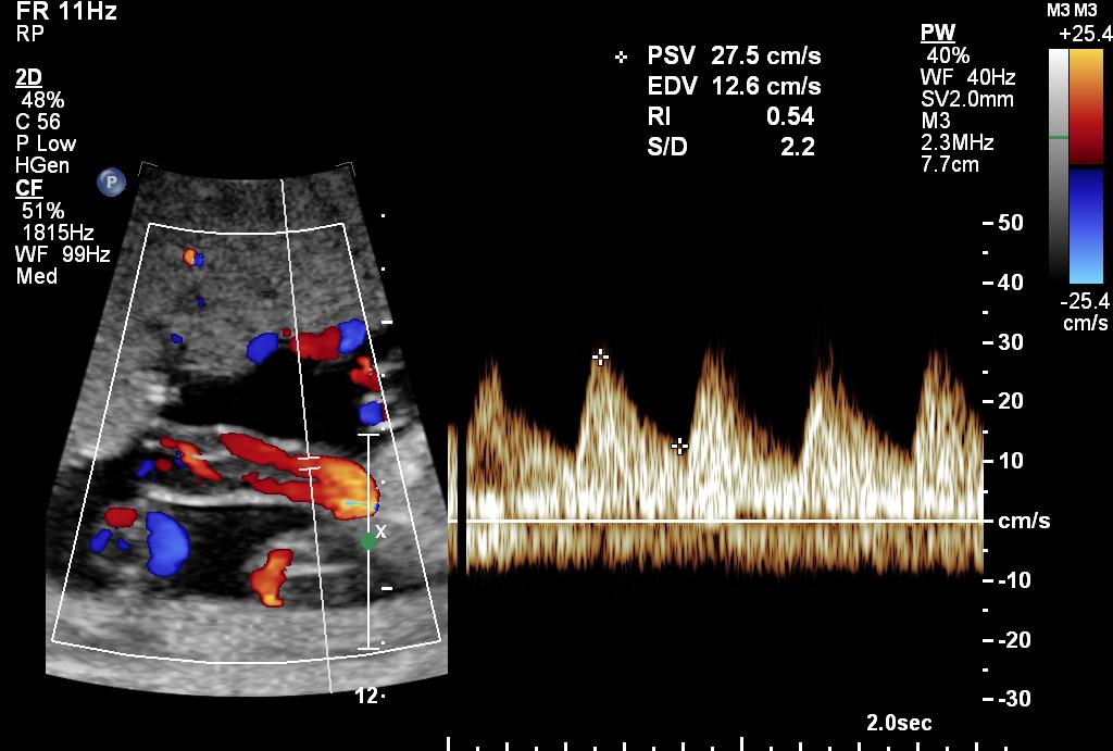 SLA2 Color and Spectral Doppler Ultrasound Umbilical artery Doppler waveform