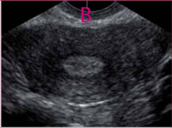 Z-Technique for the uterus in evaluation of the uterine cavity 1.