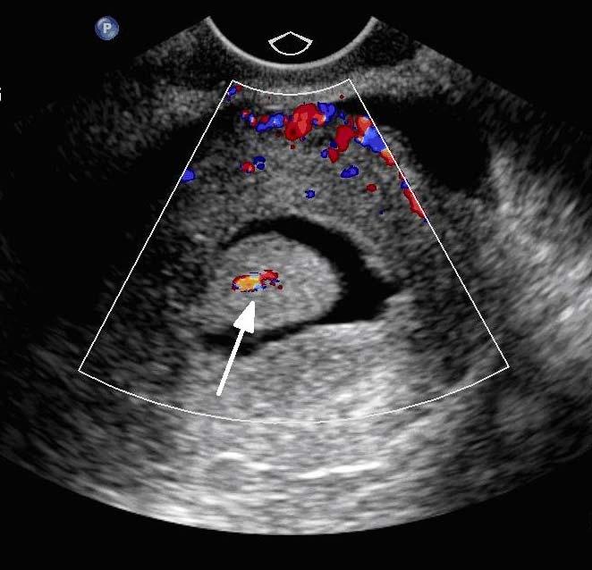SLA3 Color-flow Doppler may demonstrate the single feeding vessel typical of endometrial polyps.