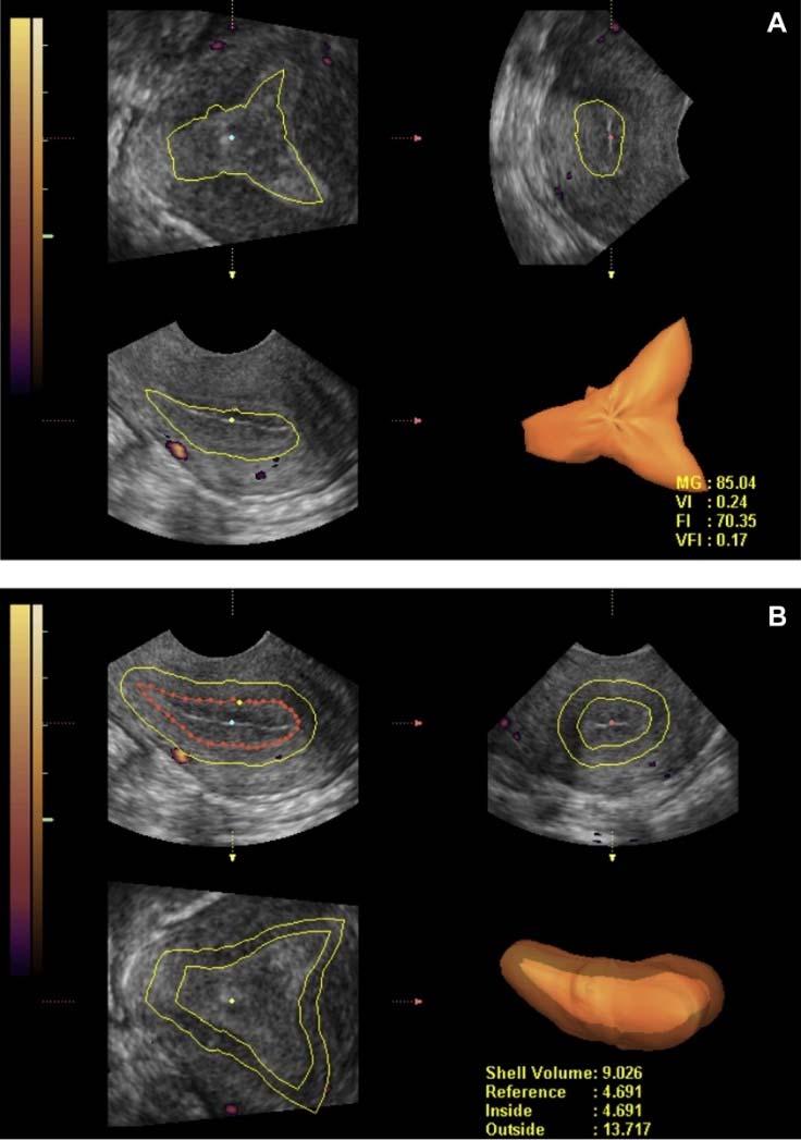 236 women with Doppler on ET:The pregnant group had a higher VI, PI and VFI than non-pregnant group better endometrial blood flow subendometrial blood flow is the same (Lee